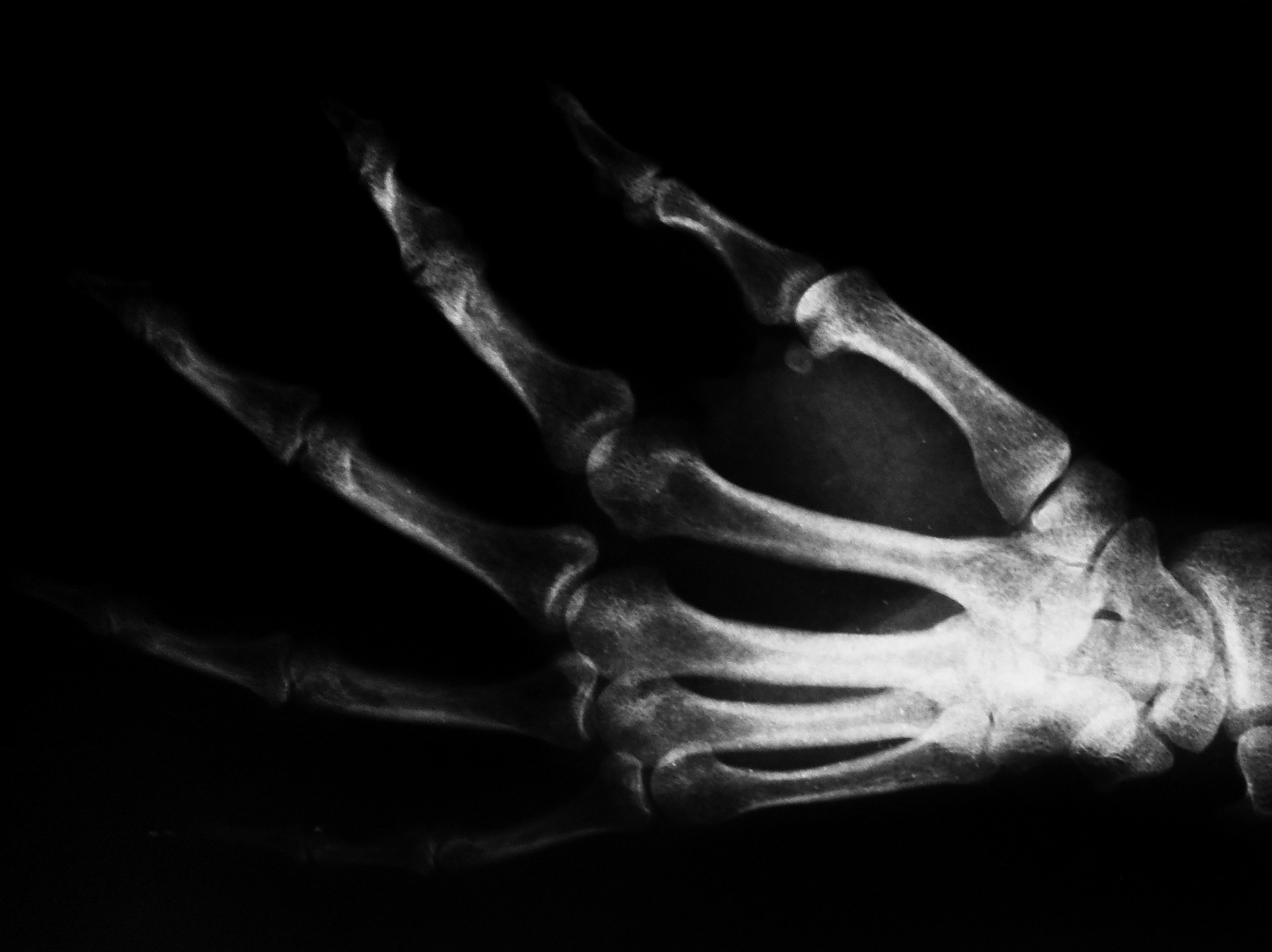 Röntgenbild rechte Hand