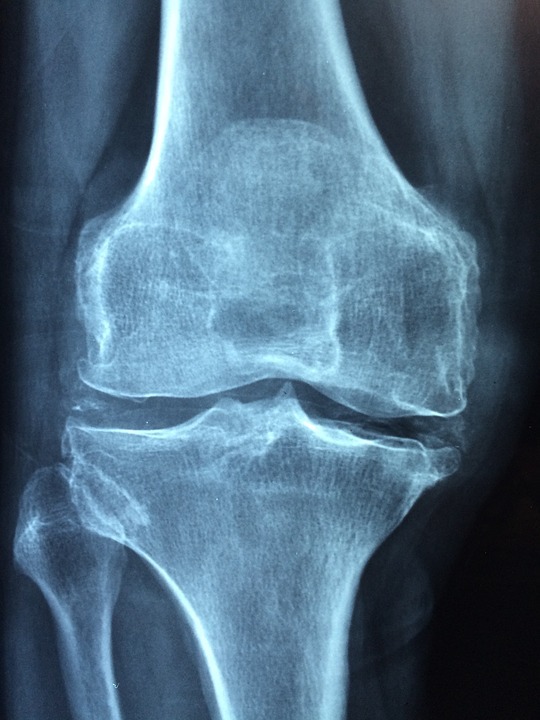 Um Schmerzen in Knie und Hüfte geht's bei einem Vortrag am Grünstadter Kreiskrankenhaus am Montag, 6. Mai.