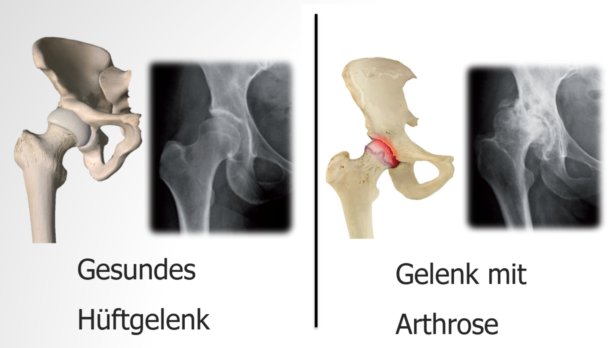 Hftoperation Kaiserslautern Kreis: Expertise mit der Amis-Methode -  Kaiserslautern