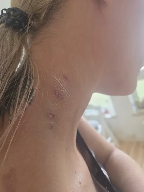 Heilen schlecht und können vernarben: Vanessa Baumgärtner hat die Blasen an ihrem Hals mit Zinksalbe behandelt | Foto: Vanessa Baumgärtner/gratis