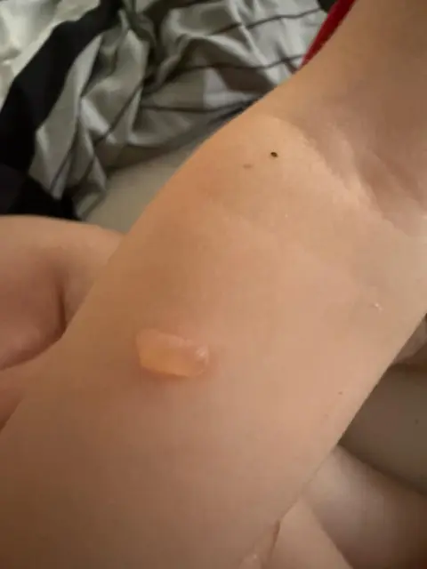 Die Folge des Gifts bei Hautkontakt: schmerzende, brennende Blasen  | Foto: Vanessa Baumgärtner/gratis