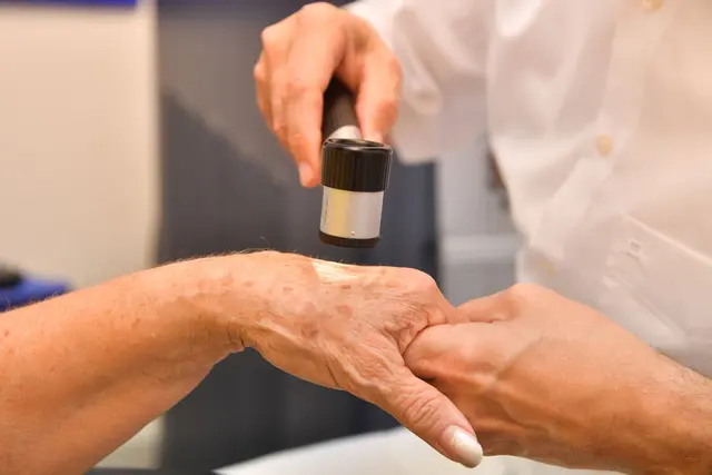 Dermatologische Praxen bieten verschiedene Methoden an, um Altersflecken dauerhaft zu entfernen. | Foto: dpa