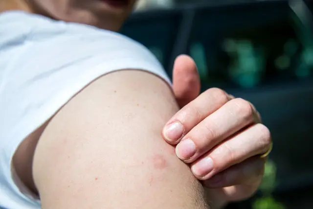 So fies er auch juckt: An einem Mückenstich sollte man nicht herumkratzen.  | Foto: dpa